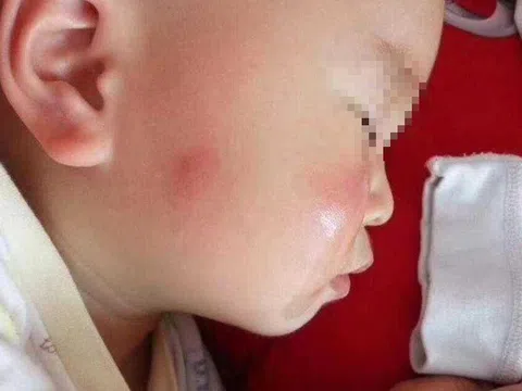 Bà nội chữa muỗi đốt theo cách lạ, cháu trai phải nhập viện cấp cứu gấp