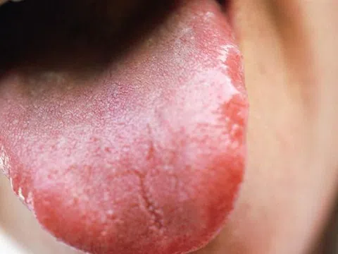 3 biểu hiện ở lưỡi cảnh báo bệnh tim nguy hiểm