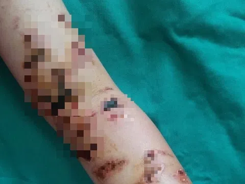 Tin tức đời sống ngày 12/5: Cơ thể bé trai 10 tuổi đầy vết thương vì bị sứa đốt