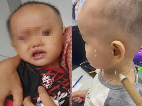 Bé trai 1 tuổi bị liệt mặt, méo miệng vì ngủ quạt sai cách