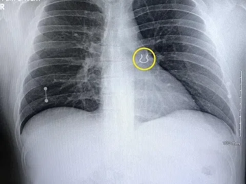 Người đàn ông nhập viện vì ho dữ dội, ảnh chụp X-quang tiết lộ điều khó tin