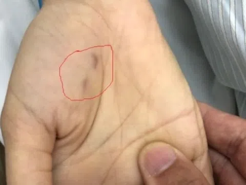 Nữ bác sĩ thú y tử vong vì vết cắn nhỏ xíu của thú cưng trên tay