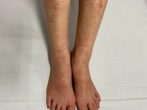 Sốt xuất huyết Dengue nguy hiểm thế nào?