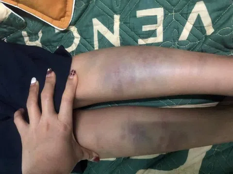 Vụ học sinh lớp 1 bị đánh bầm tím tay chân ở Đà Nẵng: Không khởi tố hình sự