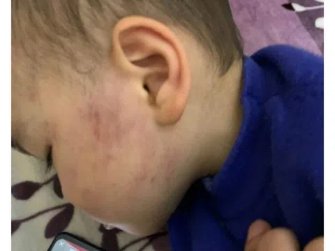 Bé trai 2 tuổi bị tát sưng một bên má ở Thái Bình: Cô giáo nói bé "ngã vào rổ đồ chơi"