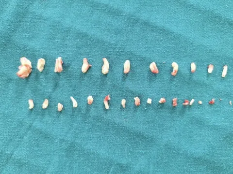 28 chiếc răng dị dạng trong khối u của em bé 9 tuổi