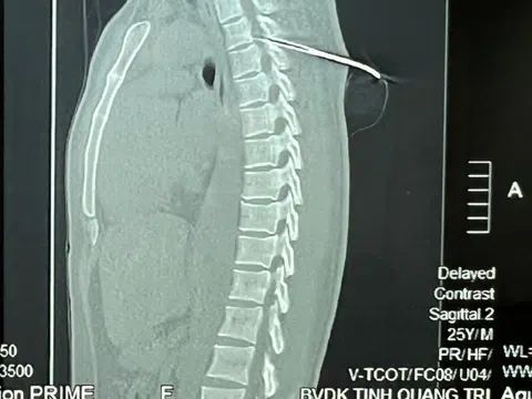 Nam thanh niên bị mũi tên bắn cá dài 7cm đâm xuyên tủy