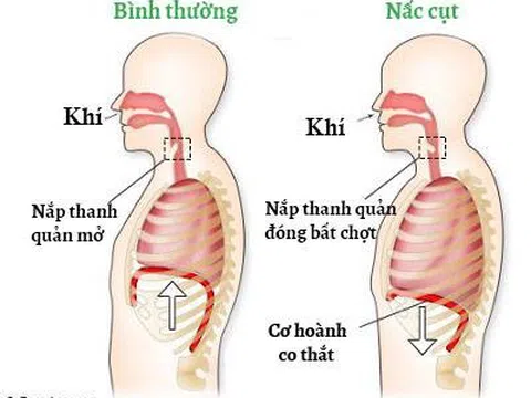 Những cách cắt cơn nấc cụt nhanh nhất