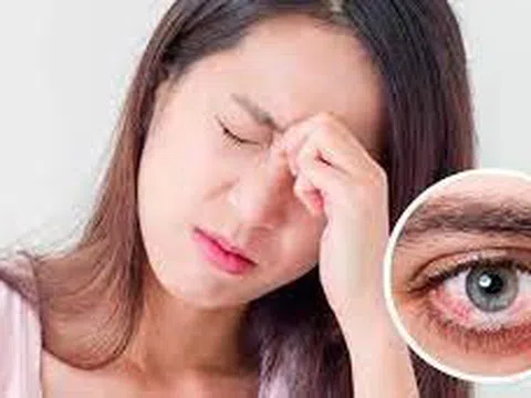 Cẩn trọng với bệnh đau mắt đỏ khi thời tiết giao mùa