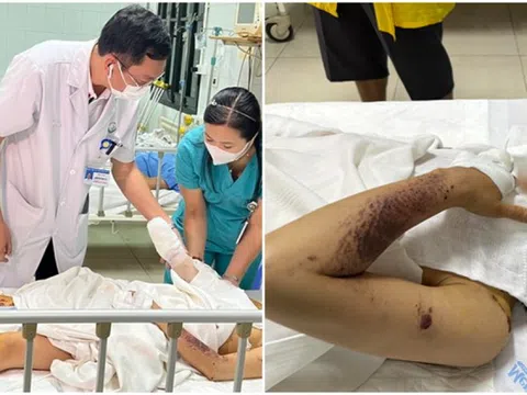 Điện thoại đang sạc phát nổ khiến người phụ nữ bị vỡ nhãn cầu, chi chít hàng trăm vết thương