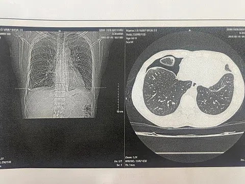 Người đàn ông suýt mất mạng sau khi ăn món gỏi cua đặc sản