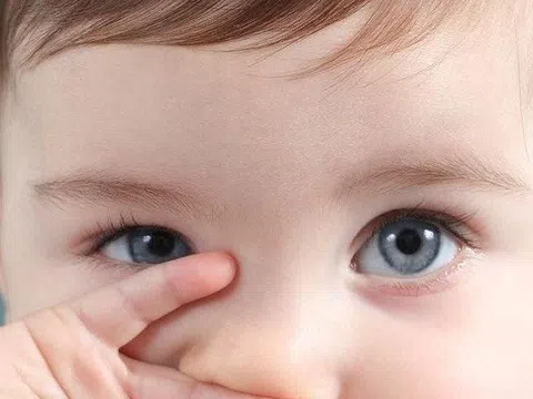 Dịch đau mắt đỏ có chiều hướng gia tăng, cha mẹ cần lưu ý những gì?