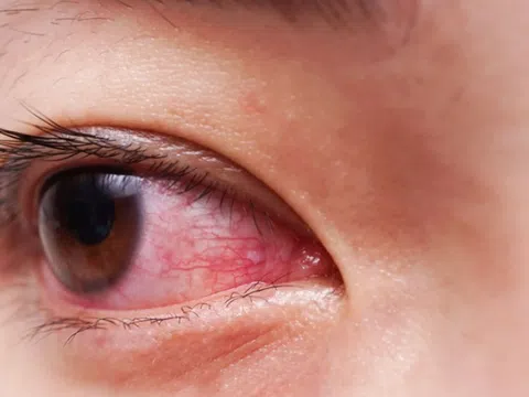 Giải đáp câu hỏi: Nhìn nhau có lây bệnh đau mắt đỏ không?