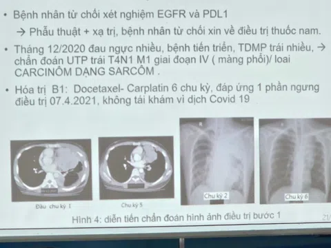 Phát hiện bệnh u phổi hiếm gặp ở người trẻ