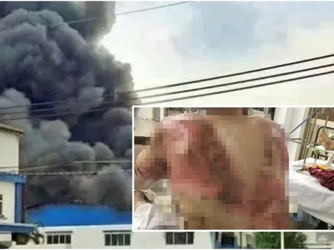 Vụ cháy lớn ở Đồng Nai: Nam công nhân bỏng nặng, khả năng phải ghép da