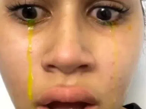 Cô gái bất ngờ khóc ra nước mắt màu vàng, nguyên nhân do đâu?