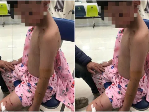 Bé trai 10 tuổi bị chó tấn công, trên người có nhiều vết thương