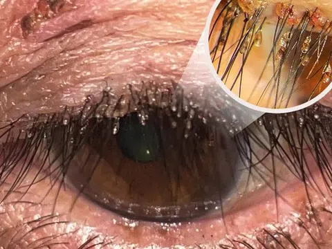 Ngứa mắt kéo dài, người phụ nữ đi khám phát hiện rận mu bám đầy lông mi