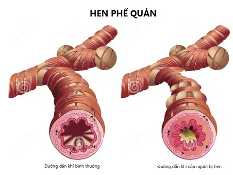 Hen suyễn ảnh hưởng lớn tới tình dục