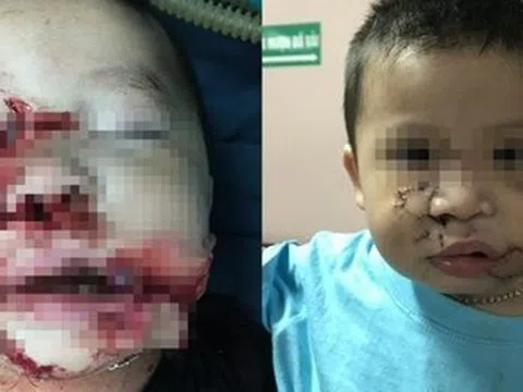 Phẫu thuật tạo hình cho bé trai 2 tuổi bị chó cắn nát mặt