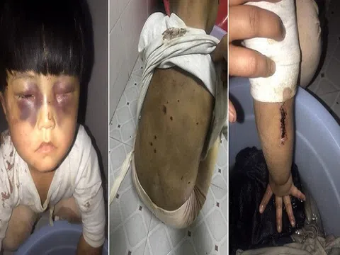 Trung Quốc: Bé gái bị bố đánh bầm tím mặt, xích trong nhà vệ sinh