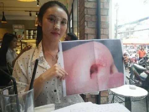 Người đẹp `tố` thẩm mĩ viện làm hỏng mũi sau khi phẫu thuật