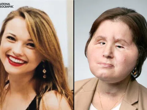 Ca phẫu thuật lịch sử dài 31 giờ trả lại gương mặt xinh đẹp cho cô gái 21 tuổi