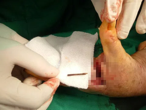 Mất 3 năm với 3 lần phẫu thuật để lấy cọng dằm tàu dừa trong bàn tay