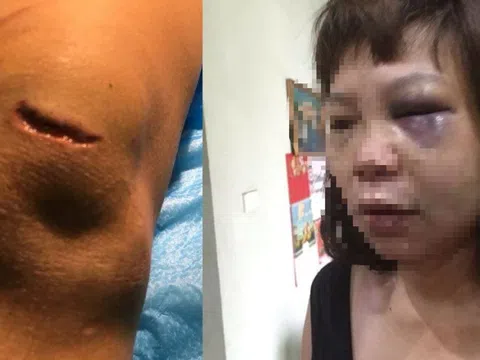 Quảng Ninh: Khởi tố gã chồng cắt gân, đánh vợ tím mặt