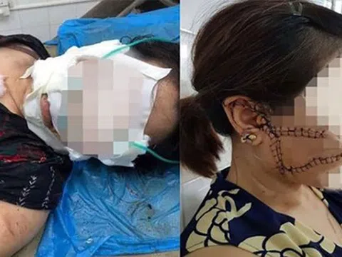 Thông tin mới nhất vụ chồng dùng dao rạch mặt, cắt gân chân `vợ hờ` ở Bắc Giang