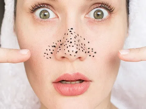 Rút gọn các bước trị mụn đầu đen cứng đầu chỉ với mặt nạ lòng trắng trứng