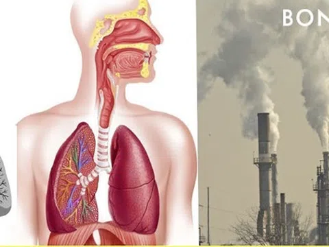 Ô nhiễm không khí giết người theo cách nào?