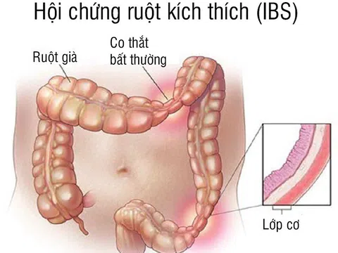 Ám ảnh Hội chứng ruột kích thích hành hạ hơn 20 năm