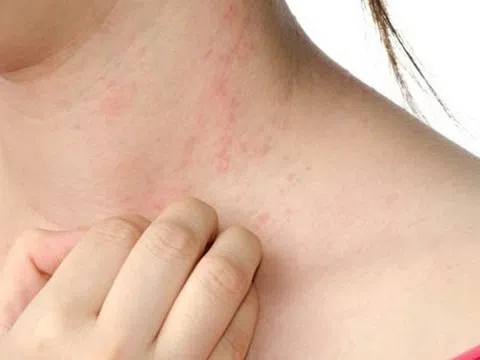 Cô gái 32 tuổi bị ung thư gan, hãi hùng khi bác sĩ chỉ ra 4 dấu hiệu này