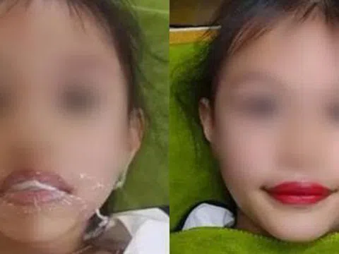 Biến chứng kinh hoàng có thể xảy ra khi xăm môi cho trẻ 5 tuổi