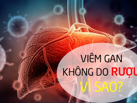 Viêm gan không do rượu: Nguyên nhân và biện pháp cải thiện