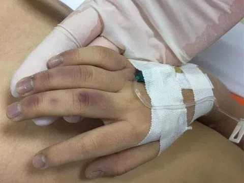 Bé gái bầm tím mặt vì bố "lỡ tay" khi dạy học: Cần khống chế cảm xúc!