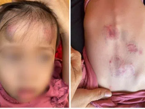 Bé gái 2 tuổi bị bạn cùng lớp đánh, đạp bầm dập trong lớp