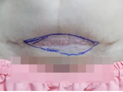 Một phụ nữ Hà Nội bị teo da bụng vì tiêm tan sẹo tại spa