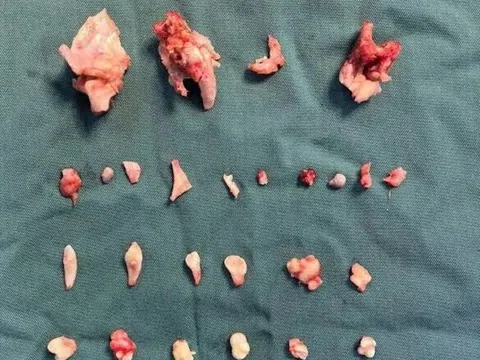 Kinh hoàng: Phát hiện khối u quái chứa 24 chiếc răng trong bụng thiếu nữ 18 tuổi