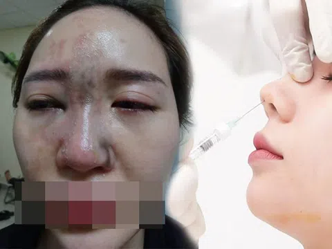 Cô em gái dại dột tiêm filler mũi tím đen cả mắt, chị gái rầu rĩ cầu cứu MXH