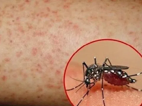 Ghi nhận một trường hợp trẻ tử vong do bệnh sốt xuất huyết Dengue