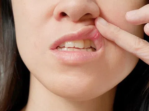 Căn bệnh nguy hiểm khiến cô gái 27 tuổi phải cắt lưỡi
