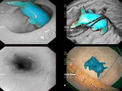Đồ chơi Pikachu kẹt trong thực quản bé trai 6 tuổi