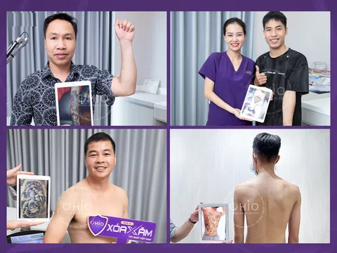 Hình ảnh kết quả Xóa xăm không sẹo bảo toàn nền da với phác đồ Pico 3X