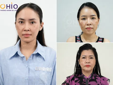 Trị nám, tàn nhang tại Vinh với phác đồ PBS Premium tại Phòng khám da liễu OHIO