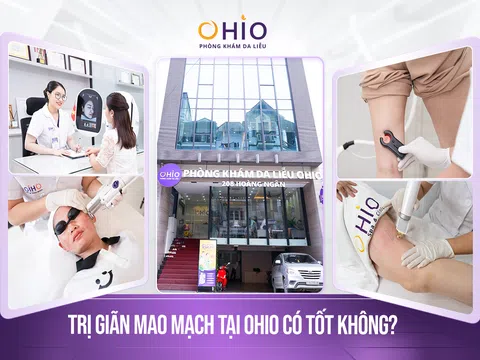 Trị giãn mao mạch tại Phòng khám da liễu OHIO có tốt không?