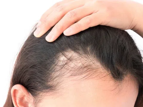 Rụng tóc, đau đầu liên tục người phụ nữ đi khám thì phát hiện căn bệnh đáng sợ