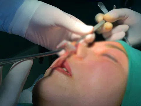 Cô gái trẻ bị thủng mũi sau làm đẹp, được "chữa cháy" sự cố bằng phương pháp tiêm kháng sinh vào vòng ba