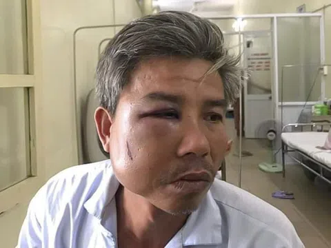 Khởi tố ông chủ quán "Bố già" đánh công nhân gãy quai hàm